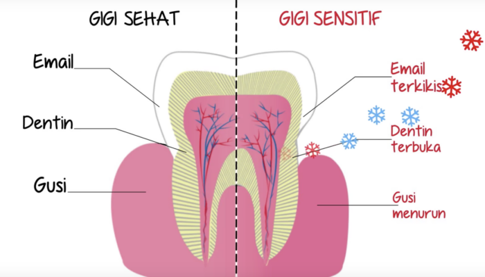 Apakah Gigi Sensitif Perlu Perhatian Khusus?