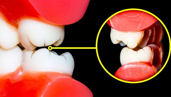 Kiat Mengatasi Kebiasaan Menggeretakkan Gigi (Bruxism)