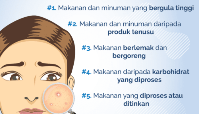 Tips Mengatasi Kulit Berjerawat Pada Remaja