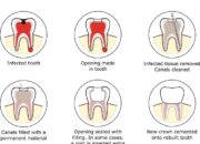 Apakah Perawatan Saluran Akar Gigi Diperlukan?