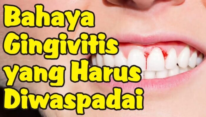 Tanda-tanda Gingivitis Yang Harus Diwaspadai