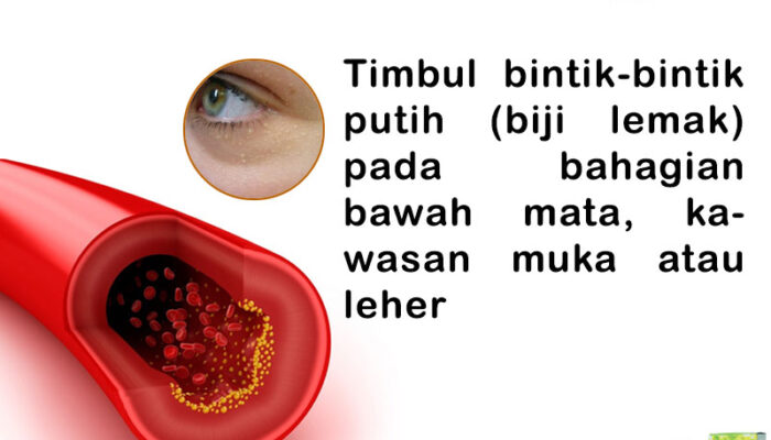 Kolesterol Dan Kesehatan Mata: Apakah Ada Hubungannya?